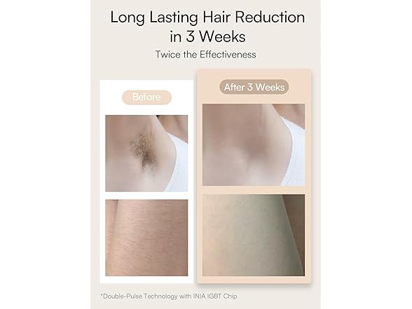 Laser Hair Removal for Women and Men