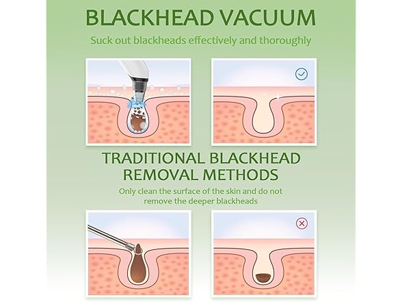 Xamoca Blackhead Remover Vacuum