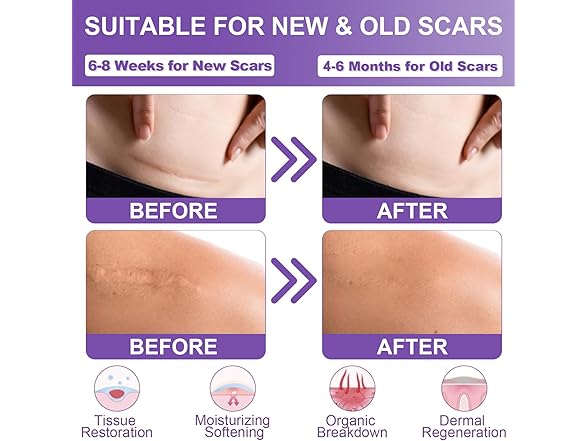 Mitgary Medical Grade Silicone Scar Tape