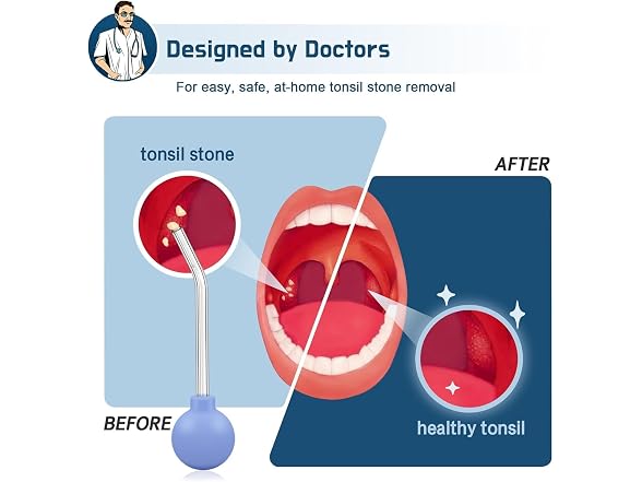Tonsil Stone Vacuum Cleaner