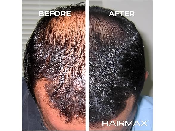 HairMax Ultima 12 LaserComb Hair