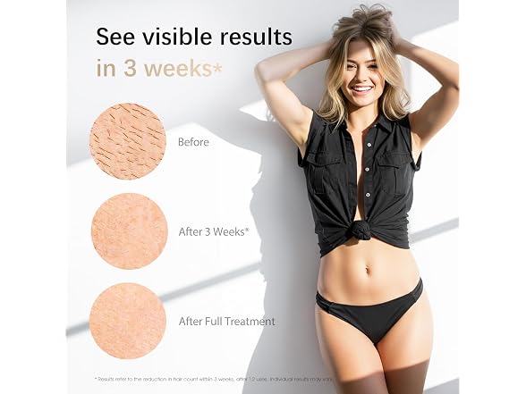 Ipl Laser Hair Removal Device