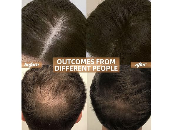 Carviki BC5385260162481 hair growth cap