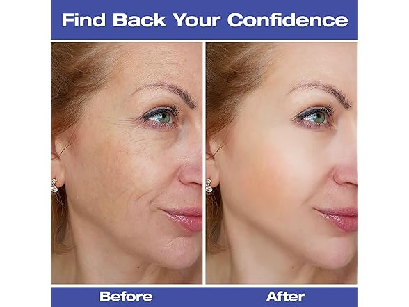 Dersie 2-pack Forehead Wrinkle Patches