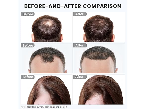 WEETALL Red Light Therapy for Hair Growth