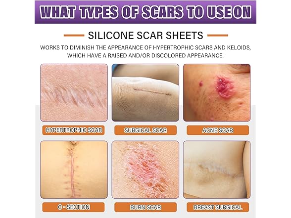 Silicone Scar Sheets (1.6"X59" Roll-1.5M)