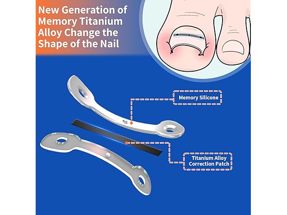 Ingrown Toenail Kit 10pc 5 Sizes