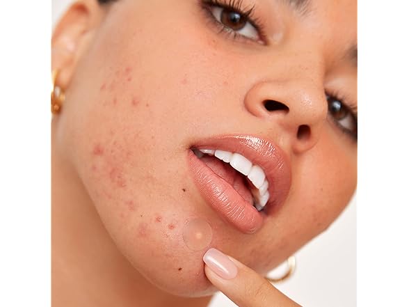 PEACE OUT Acne Healing Dots