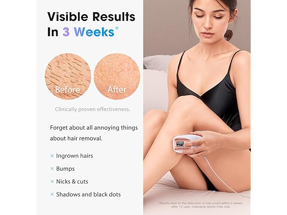 IPL Laser Hair Removal Device