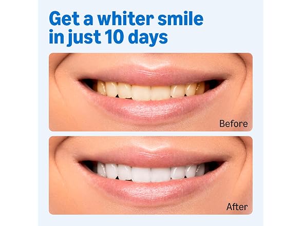 Amazon Basics Teeth Whitening Strips 10 Count