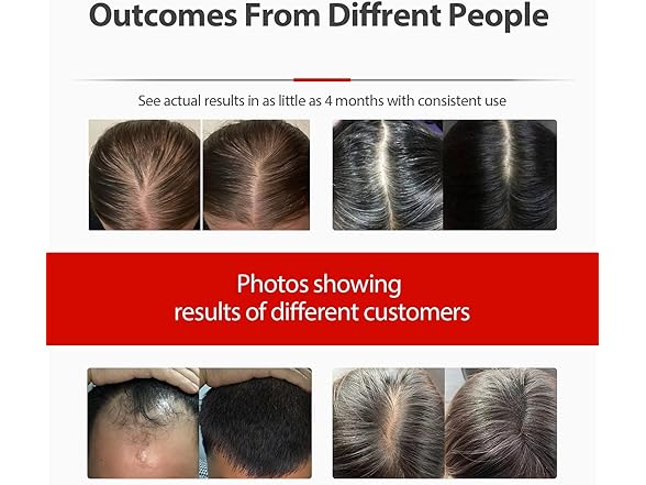 Carviki BC538525110087 Red Light Therapy Cap