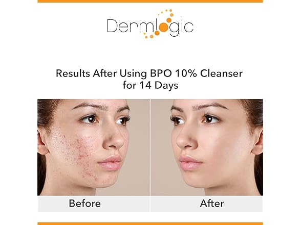 Dermlogic Acne Treatment