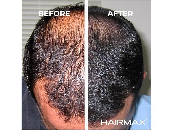 HairMax Ultima 12 LaserComb Hair