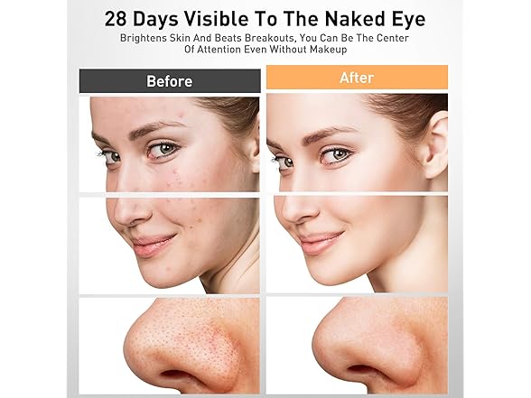 Coroever Red Light Therapy For Face