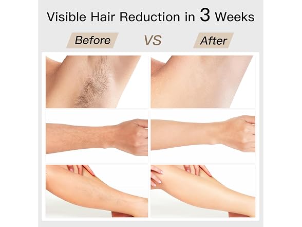 Laser Hair Removal, Bosidin Ipl Hair