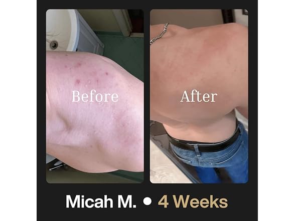 Shield Body Acne Wash