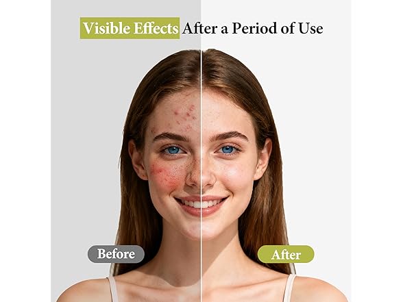 Hyuxeo Salicylic Acid Serum for Acne