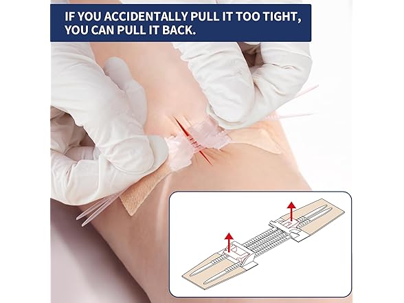 URAY  Emergency Wound Closure Device
