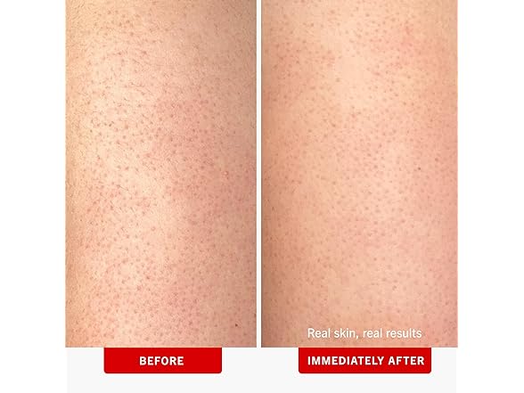 First Aid Beauty - KP Bump Eraser Body Scrub