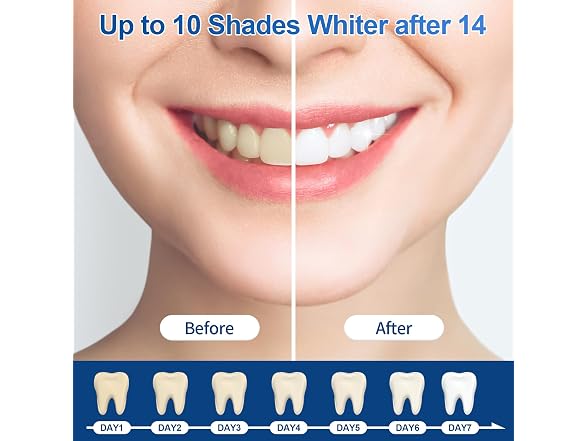 35% Ganencsnc 10-Pack Teeth Whitening