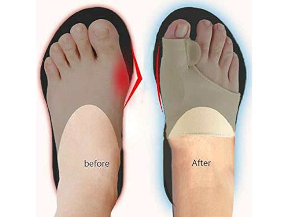 AnHua Valgus Bunion Corrector Orthotics Feet Bone