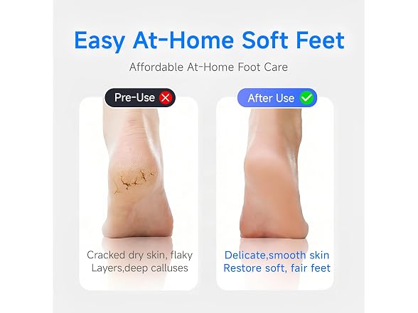 Electric Foot Callus Remover