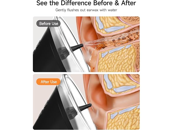 Renergy Electric Ear Wax Removal Kit