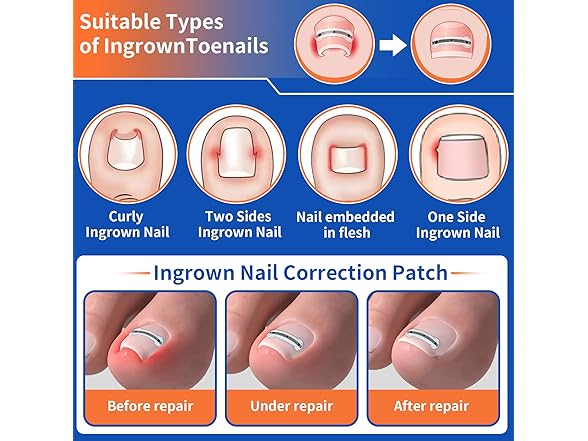 Ingrown Toenail Kit 10pc 5 Sizes