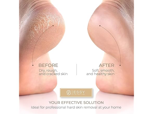 Essy Electric Foot File Hard Skin Remover