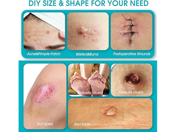 AKQFZHQ Hydrocolloid Roll for Wound Care