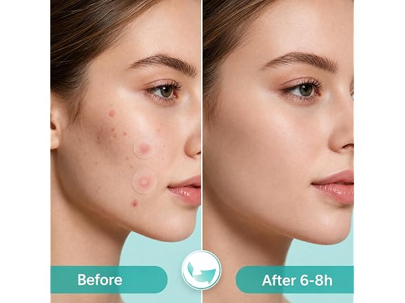 PatchCare 880pcs Pimple Patches