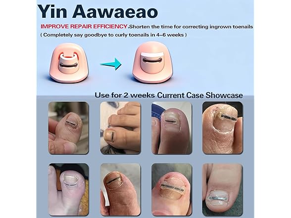 Ingrown Toenail Treatment