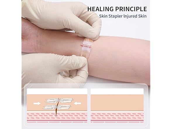 Emergency Wound Closure Device