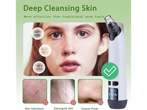 Xamoca Blackhead Remover Vacuum