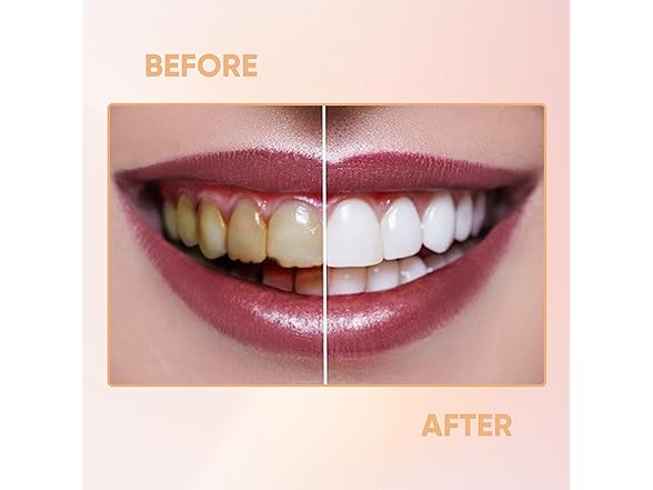 Generic  Fake Teeth SmileShaperVeneers