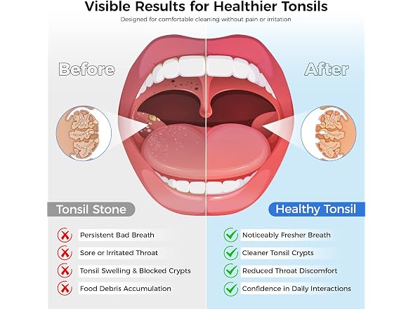 Tonsil Stone Remover Kit