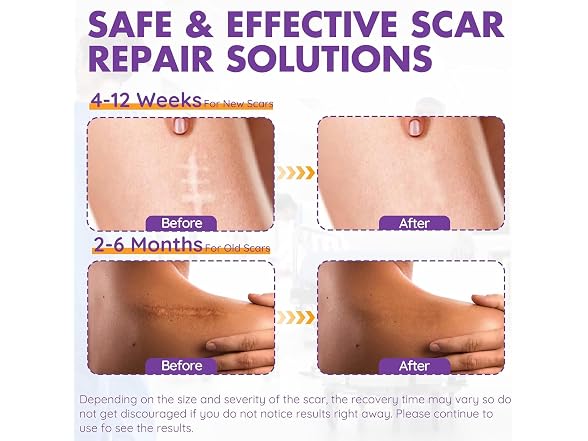 DFK Silicone Scar Sheets