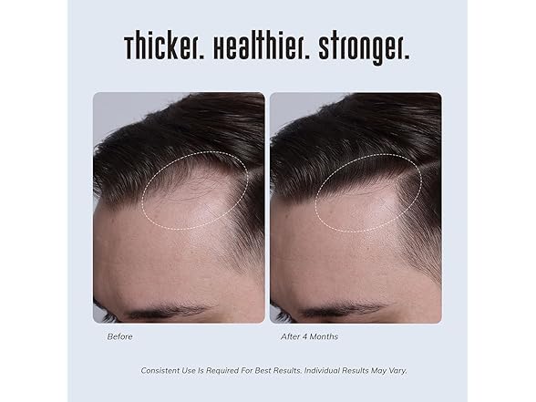 RootStim BC2118725080003 Hair Growth Shampoo