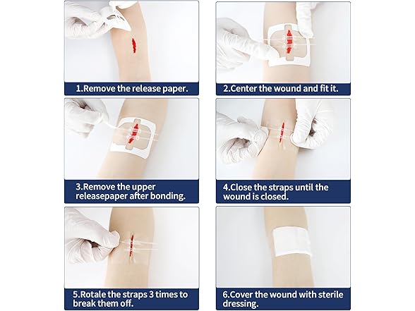 URAY  Emergency Wound Closure Device