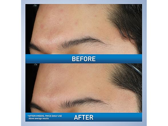 CeraVe Acne Foaming Cream Wash