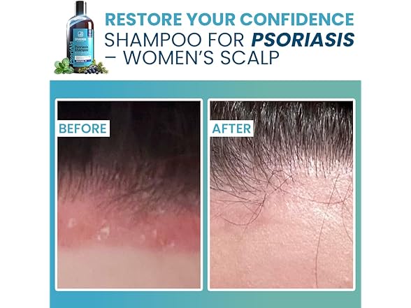 Sphagnum Psoriasis Shampoo 13.5oz