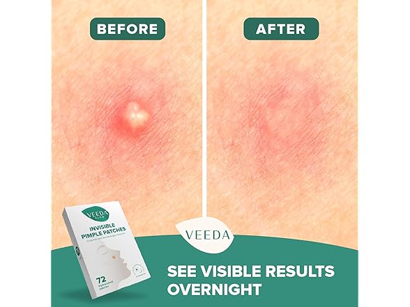 Veeda Glow Pimple Patches