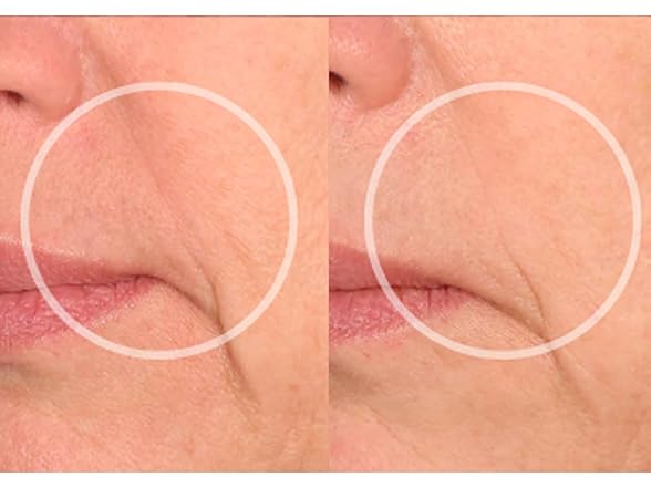 SiO Beauty Eye & Smile Lift - Eye & Smile