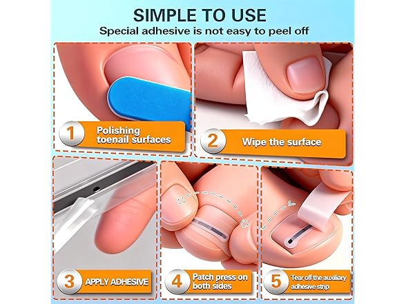 Ingrown Toenail Treatment