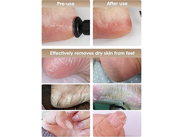 KIUCID Electric Foot Callus Remover