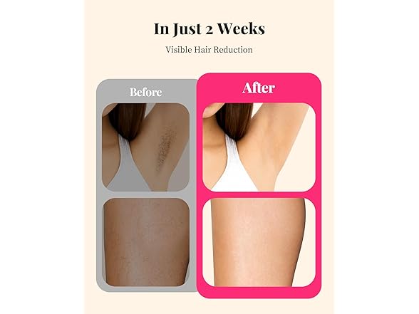 LYSMOSKI laser hair removal