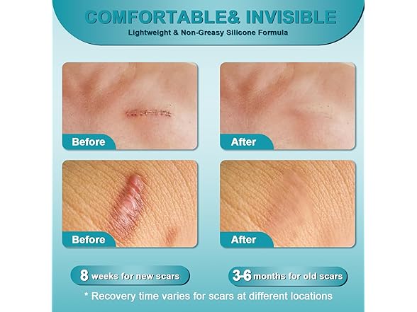 ClearPiny Advanced Scar Gel