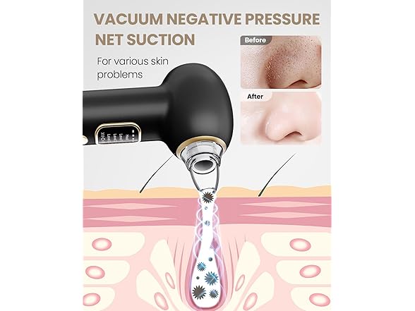 YAGETU Blackhead Remover Vacuum
