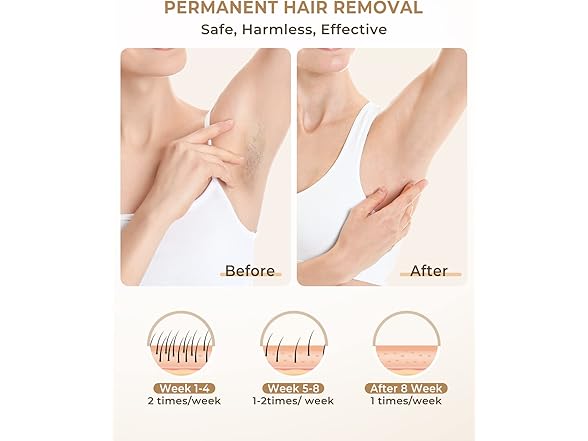 LYSMOSKI LYSMOSKI Laser Hair Removal Device for W