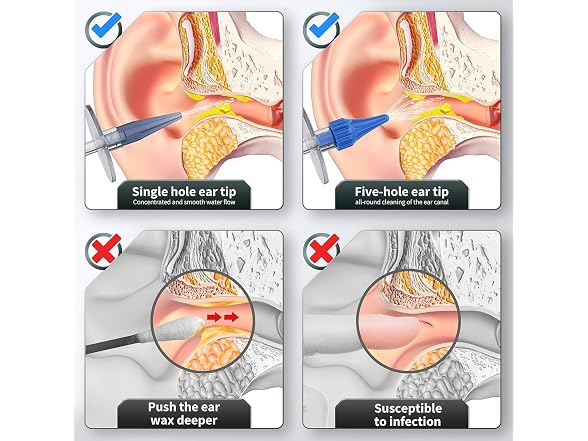 WEUANY Ear Wax Removal